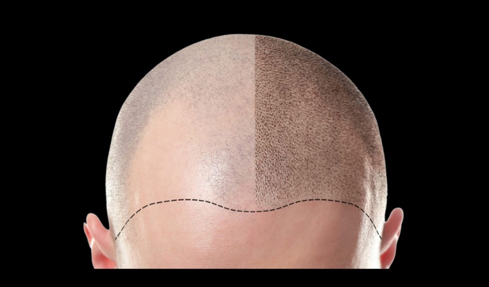scottish beauty expert scalp micropigmentation treatment