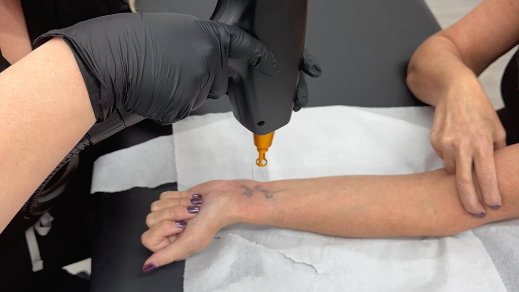 Laser Tattoo Removal